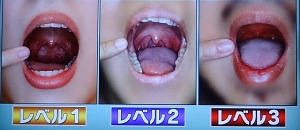 睡眠時無呼吸症候群